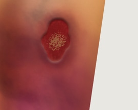 Крак с промени в цвета на  кожата или зачервяване