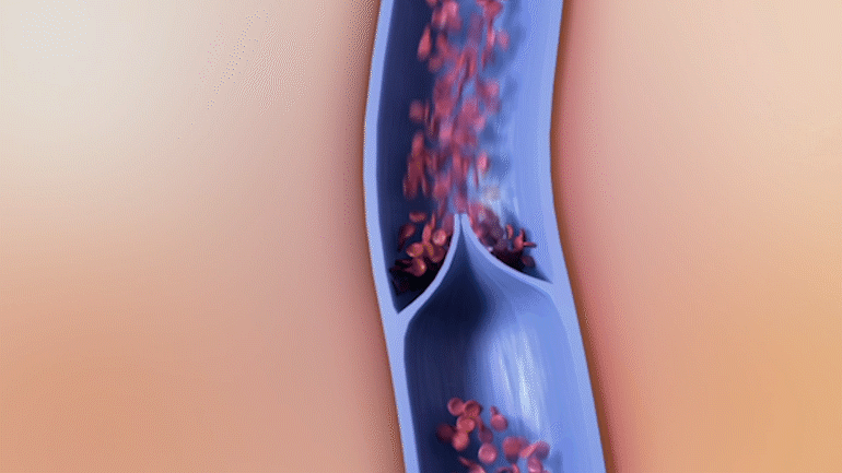 Здрава вена, с нормално свиване, което подпомага движението на кръвта към сърцето