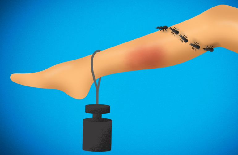 Тежест, повърхностни разширени вени и зачервяване на крак