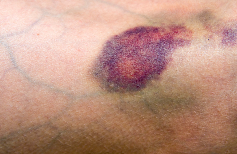 Подкожна синина със зачервяване на кожата.