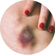 Синини и подкожни хематоми