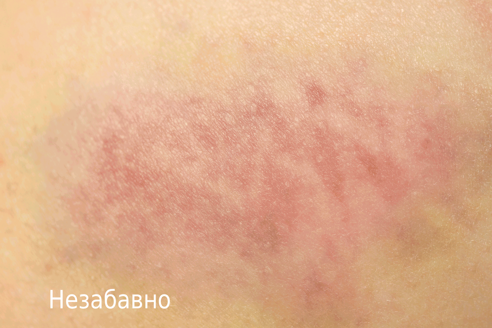 Снимка на подкожна синина с течение на времето