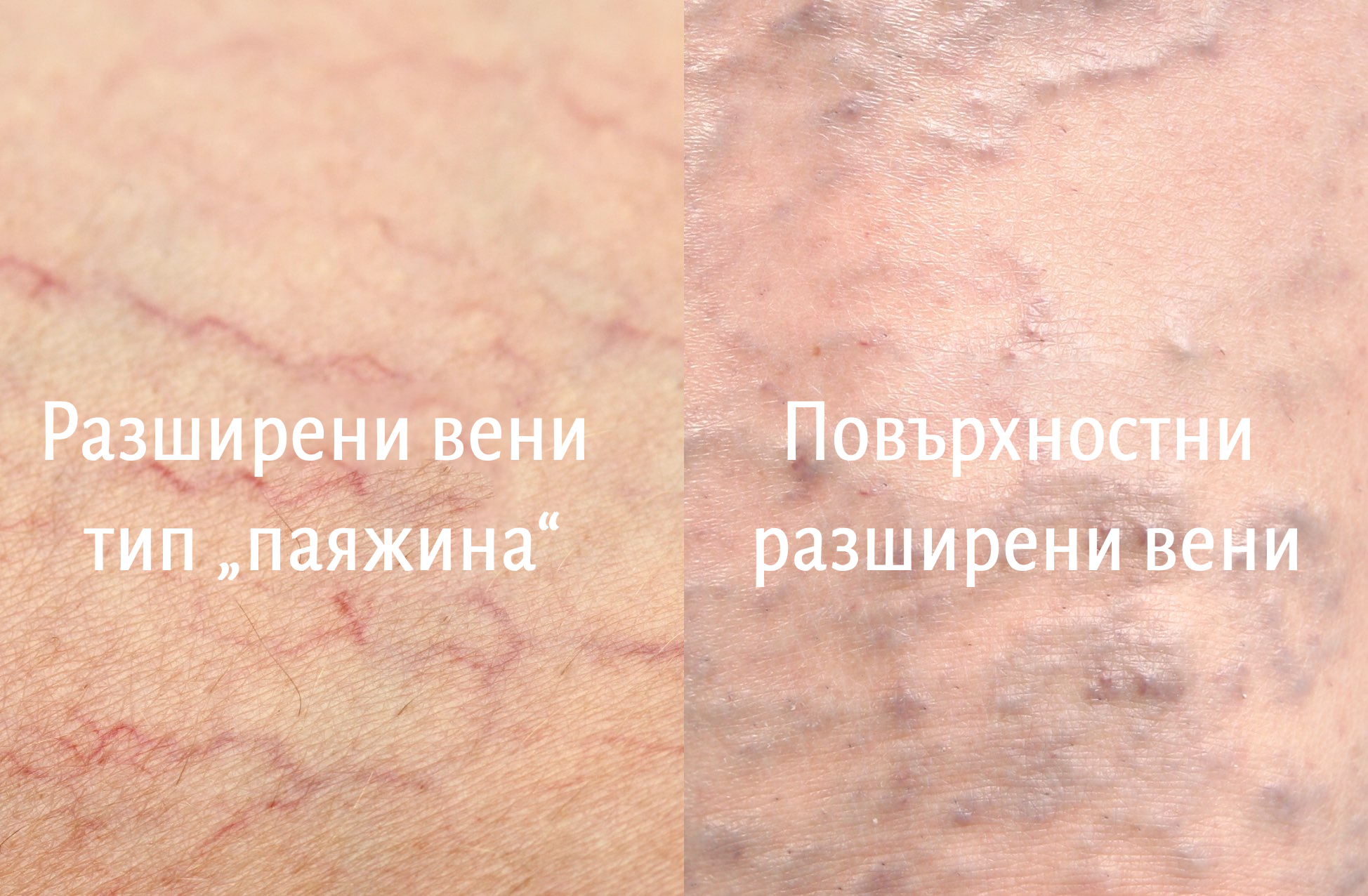 Снимка на вени тип паяжина и разширени вени за сравнение