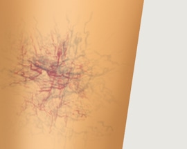 Крак с видими вени тип „паяжина“